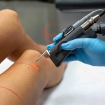 Cynosure Apogee Elite