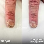 Лечение на гъбички по ноктите